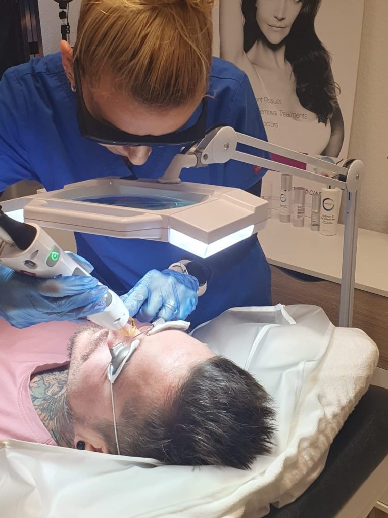 laser treatment