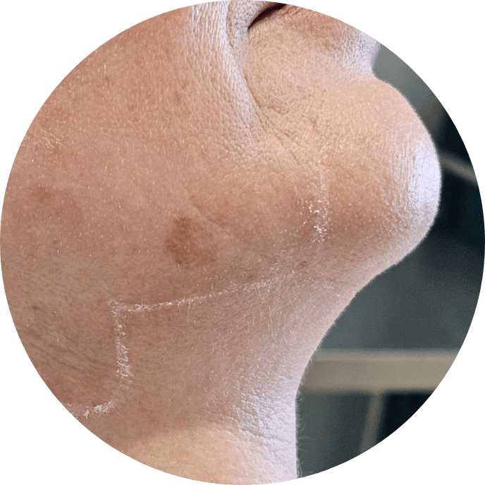 Skin Rejuvenation