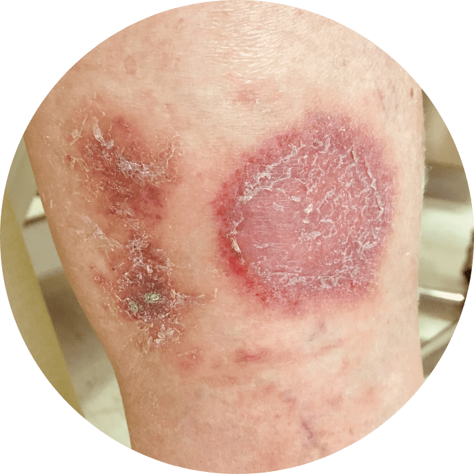Skin Lesion