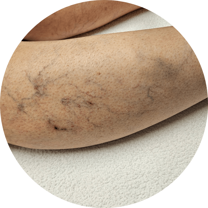 Vein Treatment