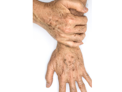 Consultation Embarking on the journey to address age spots through laser therapy begins with a detailed consultation. In this session, the clinician carefully examines the age spots, discusses the Age spots