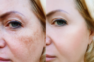 before and after Sun damage