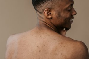 skin pigmentation
