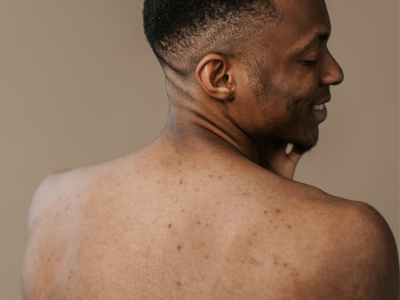 skin pigmentation