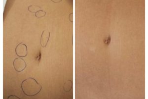 cheery angiomas before and after