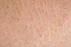rough dry skin