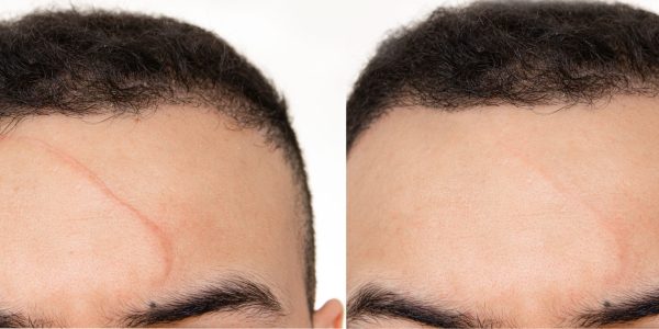 scar scar before and after