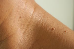 skin tags