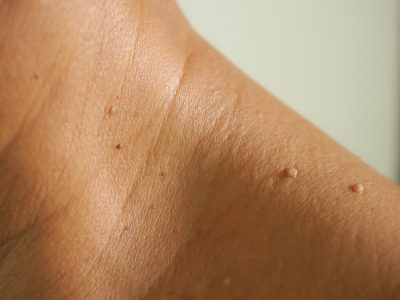 Close-up,The,Skin,Tags,On,Neck,Man,Skin. skin tags