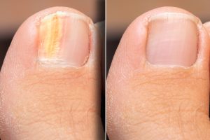 fungal nail