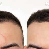 Comparison,Of,Before,And,After,Scar,Revision,(treatment,),Using