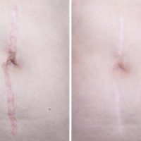 body scarring before and after image following laser treatment