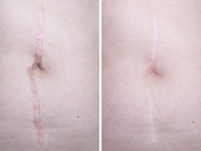 Hypertrophic,Keloid,Scar,On,Woman,Face,Before,And,After,Laser body scarring before and after image following laser treatment