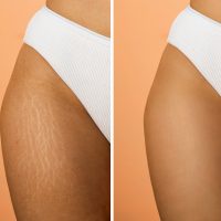 before and after stretch marks treatment with laser therapy