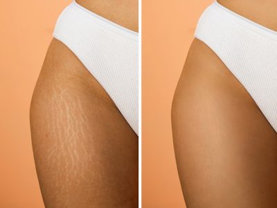 before and after stretch marks treatment with laser therapy