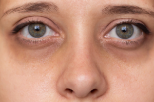Under eye dark circles
