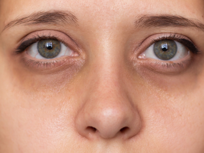 under eye Under eye dark circles