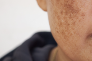 uneven skin tone