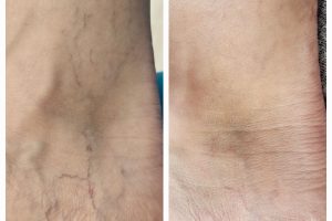 vein treatment before and after